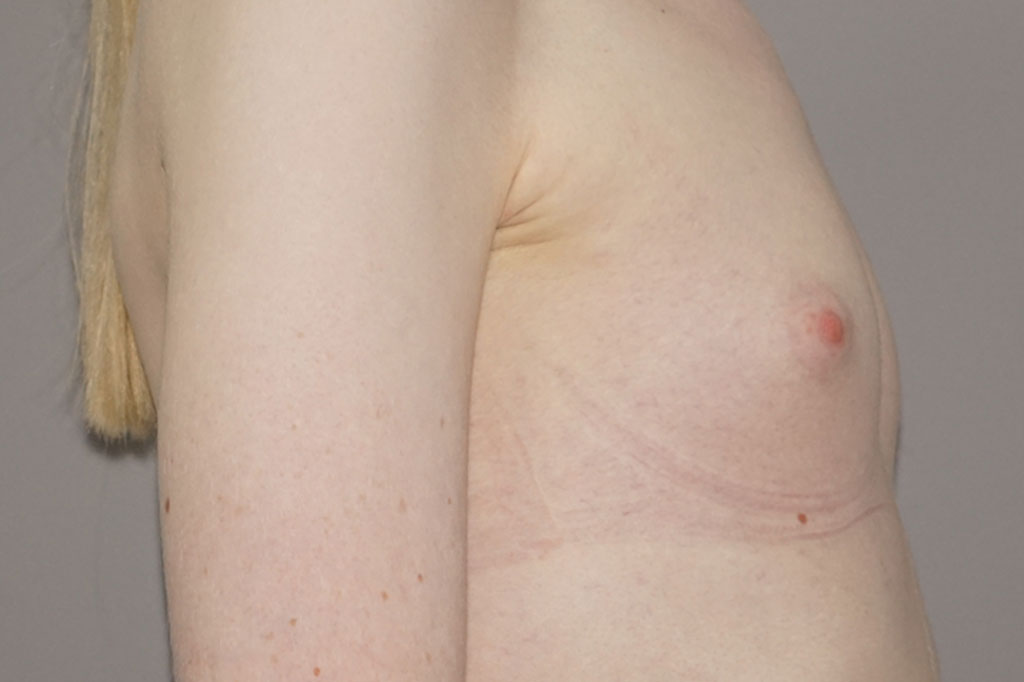 Mujeres transexuales Aumento de pechos paciente transgénero 27 años 05