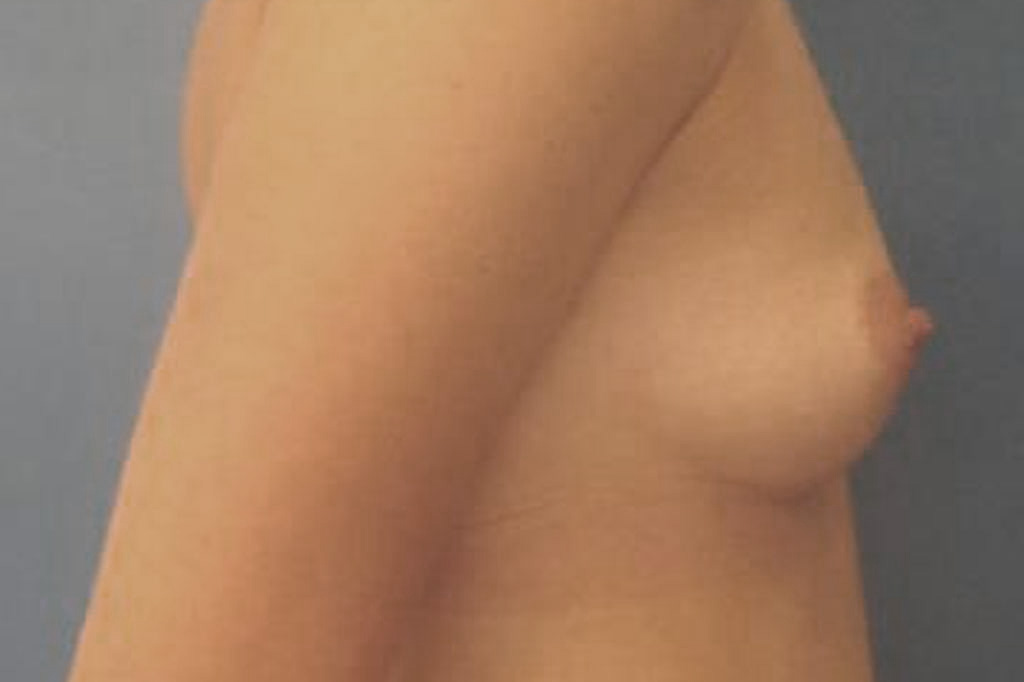 Cambio de sexo Antes y el después Mastectomía 2 semanas postoperatorio 05