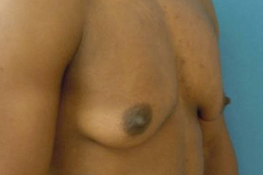 Cambio de sexo Antes y el después Mastectomía postoperatorio hombre trans 03